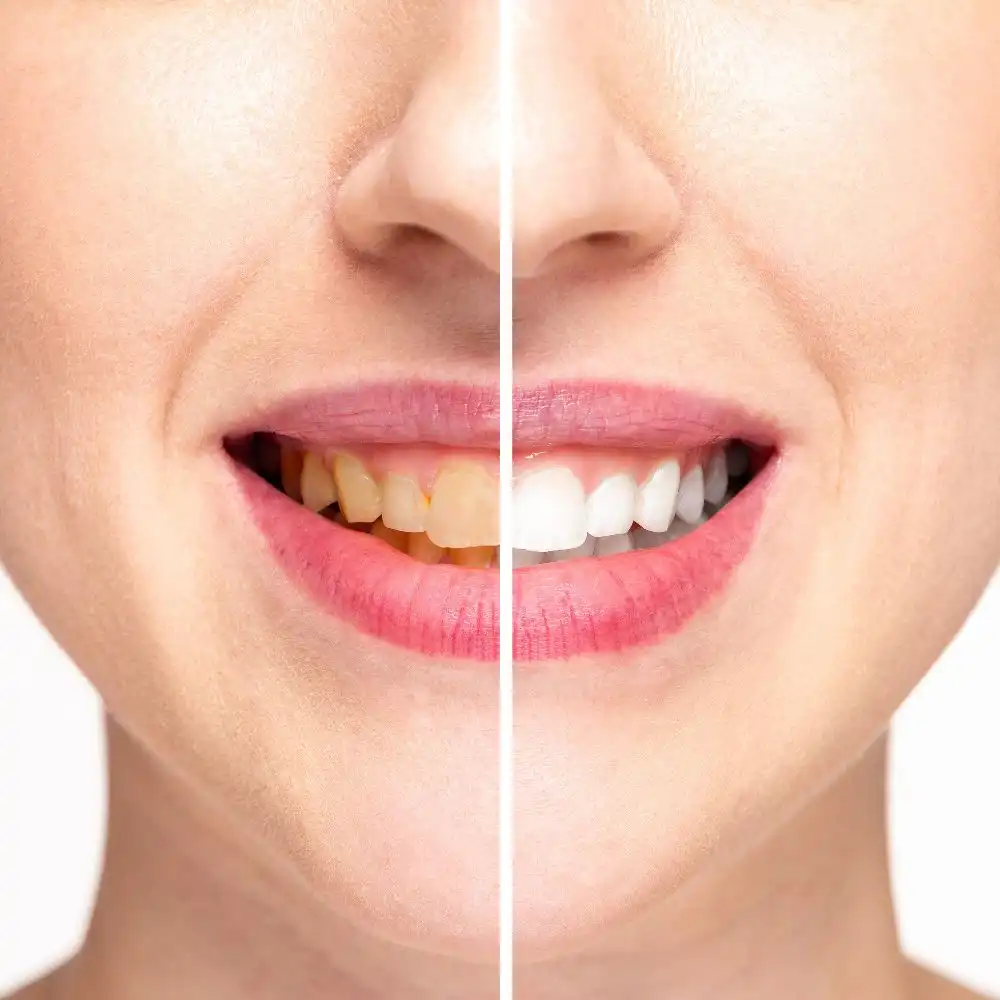 Teeth Whitening Goodlettsville